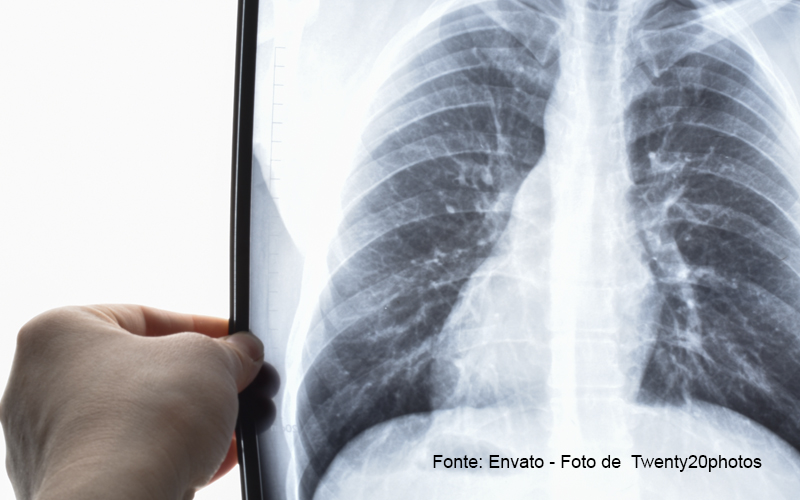 Pneumonia: sintomas mais comuns e 5 dicas de prevenção!