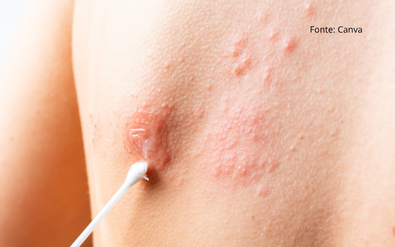 O que é Herpes-zóster?